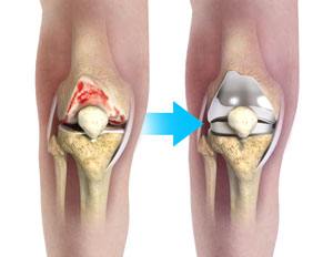 Symptoms of Wrong Size Knee Replacement